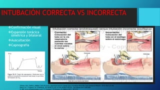 INTUBACIÓN CORRECTA VS INCORRECTA
Confirmación visual
Expansión torácica
simétrica y bilateral
Auscultación
Capnografia
Gómez. M.A. Gaitini.L.Matter.I.Smri.M.Guía y algoritmos para el manejo de la vía aérea difícil Rev Esp Anesteciol Reanim. 2016; 65(1):41-48.
María. M. F. Eugenio. M. H MANUAL DE MANEJO DE LA VIA AEREA DIFICIL. 3ra Edicion.2017.245-265.
El ABC de la anestesiología.Luna.P.O.Hurtado.C.R.Romero.J.B. México 2011: 197-213
 