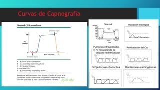 Curvas de Capnografía
 