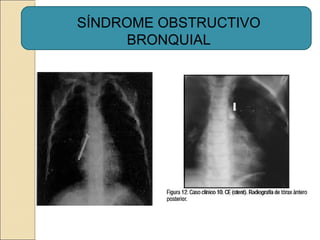 SÍNDROME OBSTRUCTIVO
BRONQUIAL
 