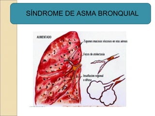 SÍNDROME DE ASMA BRONQUIAL
 