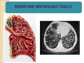 SÍNDROME BRONQUIECTÁSICO
 