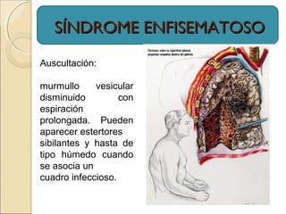 Auscultación:
murmullo vesicular
disminuido con
espiración
prolongada. Pueden
aparecer estertores
sibilantes y hasta de
tipo húmedo cuando
se asocia un
cuadro infeccioso.
SÍNDROME ENFISEMATOSOSÍNDROME ENFISEMATOSO
 