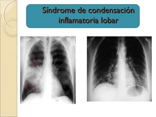 Síndrome de condensaciónSíndrome de condensación
inflamatoria lobarinflamatoria lobar
 