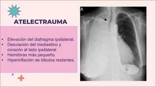 ATELECTRAUMA
• Elevación del diafragma ipsilateral.
• Desviación del mediastino y
corazón al lado ipsilateral
• Hemitòrax más pequeño.
• Hiperinflación de lóbulos restantes.
 