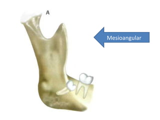 Mesioangular
 