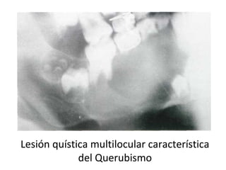 Lesión quística multilocular característica
del Querubismo
 