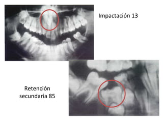 Impactación 13
Retención
secundaria 85
 
