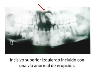Incisivo superior izquierdo incluido con
una vía anormal de erupción.
 