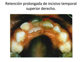 Retención prolongada de incisivo temporal
superior derecho.
 