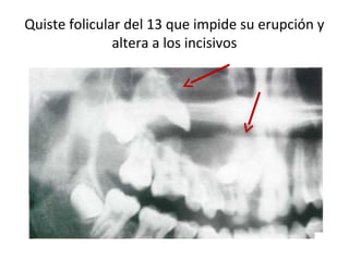Quiste folicular del 13 que impide su erupción y
altera a los incisivos
 