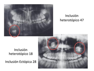 Inclusión
heterotópico 47
Inclusión
heterotópico 18
Inclusión Ectópica 28
 