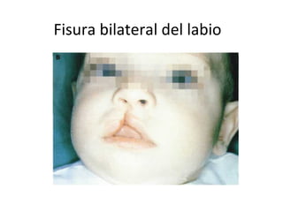 Fisura bilateral del labio
 