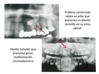 Prótesis construida
sobre un pilar que
presenta un diente
incluido en su zona
apical.
Diente incluido que
presenta grave
malformación
coronodentaria
 