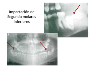 Impactación de
Segundo molares
inferiores
 