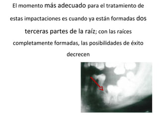 El momento más adecuado para el tratamiento de
estas impactaciones es cuando ya están formadas dos
terceras partes de la raíz; con las raíces
completamente formadas, las posibilidades de éxito
decrecen
 