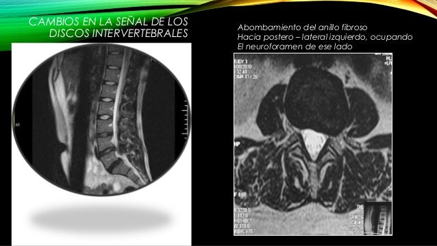 Como curar la osteocondrosis y la hernia de la columna vertebral