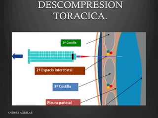 DESCOMPRESION
TORACICA.
ANDRES AGUILAR
 