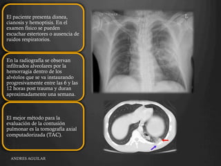 El paciente presenta disnea,
cianosis y hemoptisis. En el
examen físico se pueden
escuchar estertores o ausencia de
ruidos respiratorios.
En la radiografía se observan
infiltrados alveolares por la
hemorragia dentro de los
alvéolos que se va instaurando
progresivamente entre las 6 y las
12 horas post trauma y duran
aproximadamente una semana.
El mejor método para la
evaluación de la contusión
pulmonar es la tomografía axial
computadorizada (TAC).
ANDRES AGUILAR
 