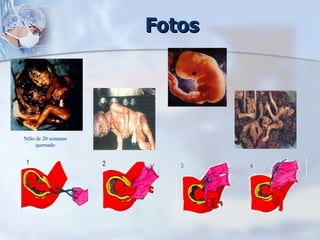 Fotos Niño de 20 semanas quemado 