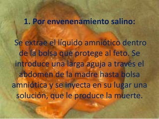 1. Por envenenamiento salino:Se extrae el líquido amniótico dentro de la bolsa que protege al feto. Se introduce una larga aguja a través el abdomen de la madre hasta bolsa amniótica y se inyecta en su lugar una solución, que le produce la muerte. 