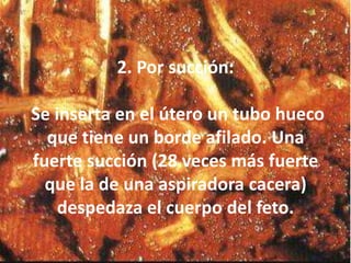 2. Por succión:Se inserta en el útero un tubo hueco que tiene un borde afilado. Una fuerte succión (28 veces más fuerte que la de una aspiradora cacera) despedaza el cuerpo del feto.