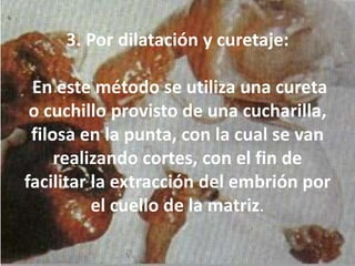 3. Por dilatación y curetaje:En este método se utiliza una cureta o cuchillo provisto de una cucharilla, filosa en la punta, con la cual se van realizando cortes, con el fin de facilitar la extracción del embrión por el cuello de la matriz.