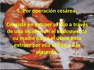 5. Por operación cesárea: Consiste en extraer al hijo a través de una incisión en el abdomen de su madre hasta el útero para extraer por ella el hijo y a la placenta. 