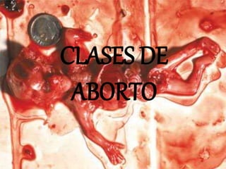 CLASES DE
ABORTO
 