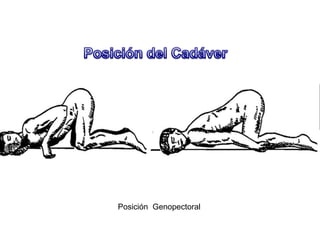 Posición Genopectoral
 