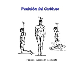 Posición suspensión incompleta
 