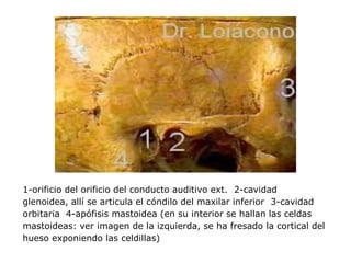 1-orificio del orificio del conducto auditivo ext. 2-cavidad
glenoidea, allí se articula el cóndilo del maxilar inferior 3-cavidad
orbitaria 4-apófisis mastoidea (en su interior se hallan las celdas
mastoideas: ver imagen de la izquierda, se ha fresado la cortical del
hueso exponiendo las celdillas)
 