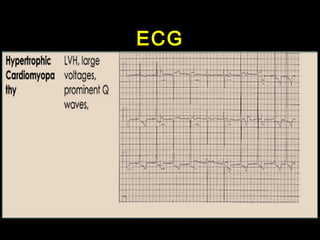 ECG 
 