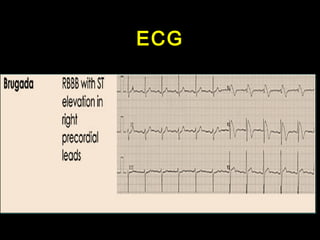 ECG 
 