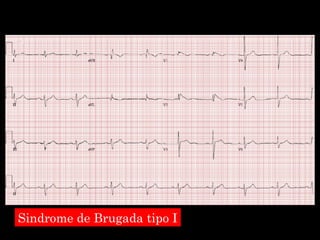 Sindrome de Brugada tipo I 
 