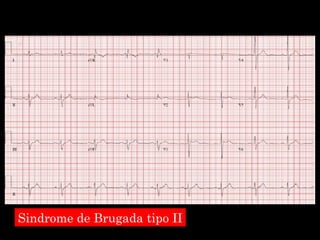 Sindrome de Brugada tipo II 
 