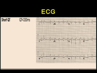 ECG 
 