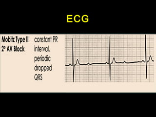 ECG 
 