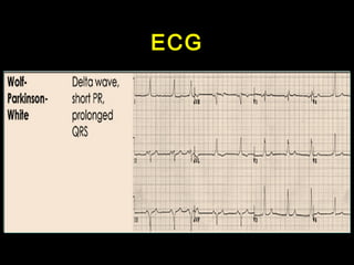 ECG 
 