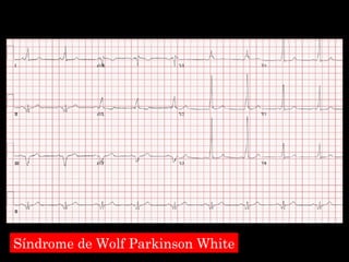 Síndrome de Wolf Parkinson White 
 