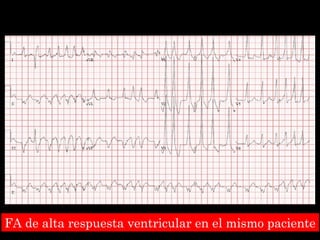 FA de alta respuesta ventricular en el mismo paciente 
 