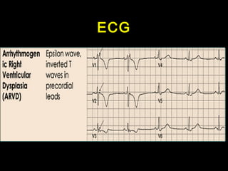 ECG 
 