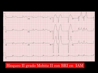 Bloqueo II grado Mobitz II con BRI en IAM 
 