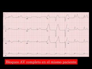 Bloqueo AV completo en el mismo paciente 
 