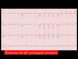 Sindrome de QT prolongado postparo 
 