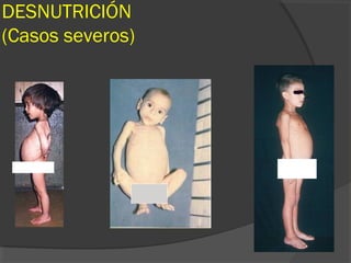 DESNUTRICIÓN
(Casos severos)
 