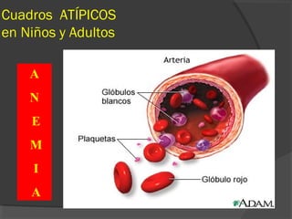 Cuadros ATÍPICOS
en Niños y Adultos
A
N
E
M
I
A
 