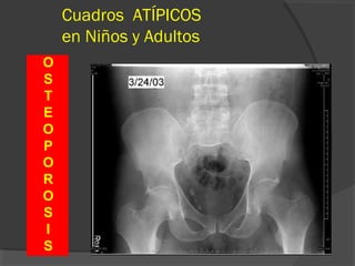 Cuadros ATÍPICOS
en Niños y Adultos
O
S
T
E
O
P
O
R
O
S
I
S
 