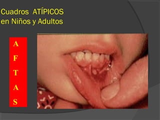 Cuadros ATÍPICOS
en Niños y Adultos
A
F
T
A
S
 