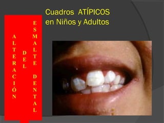 Cuadros ATÍPICOS
en Niños y Adultos
A
L
T
E
R
A
C
I
Ó
N
D
E
L
E
S
M
A
L
T
E
D
E
N
T
A
L
 