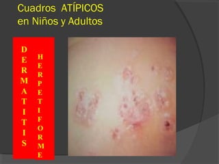 Cuadros ATÍPICOS
en Niños y Adultos
D
E
R
M
A
T
I
T
I
S
H
E
R
P
E
T
I
F
O
R
M
E
 